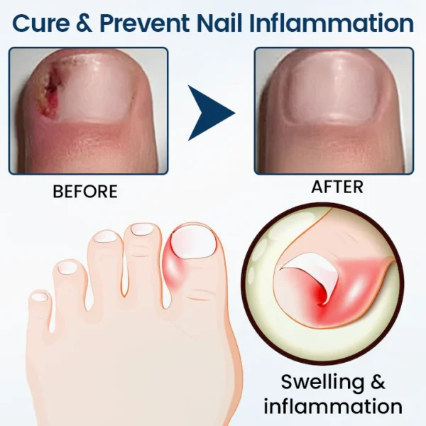✨Ourlyard® NailGuard Fungal Repair Herbal Spray