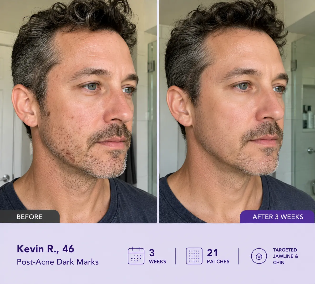 Leanviy Dark Spot Removal Patch|Nano Microneedle Technology · Visible Results in 7 Days