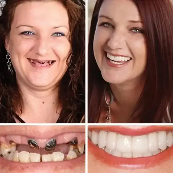 Heaceitr® Premium Full Denture Set