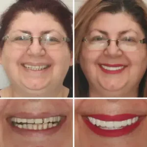 Vaxflite™ PREMIUM DENTURES