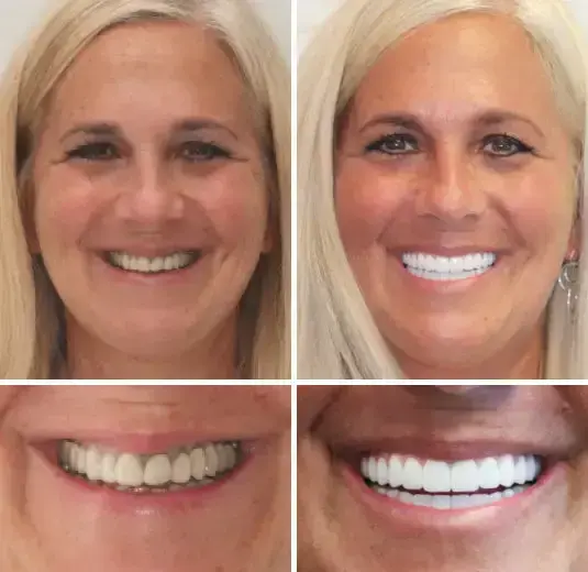 Vaxflite™ PREMIUM DENTURES